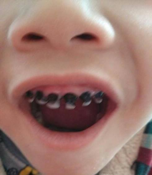 幼儿牙齿全部烂了怎么办?